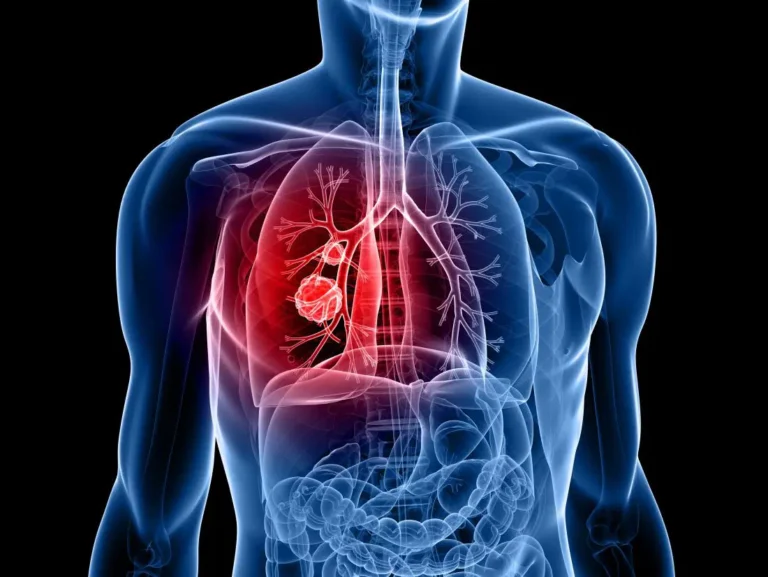 Medical illustration of lung cancer in the chest